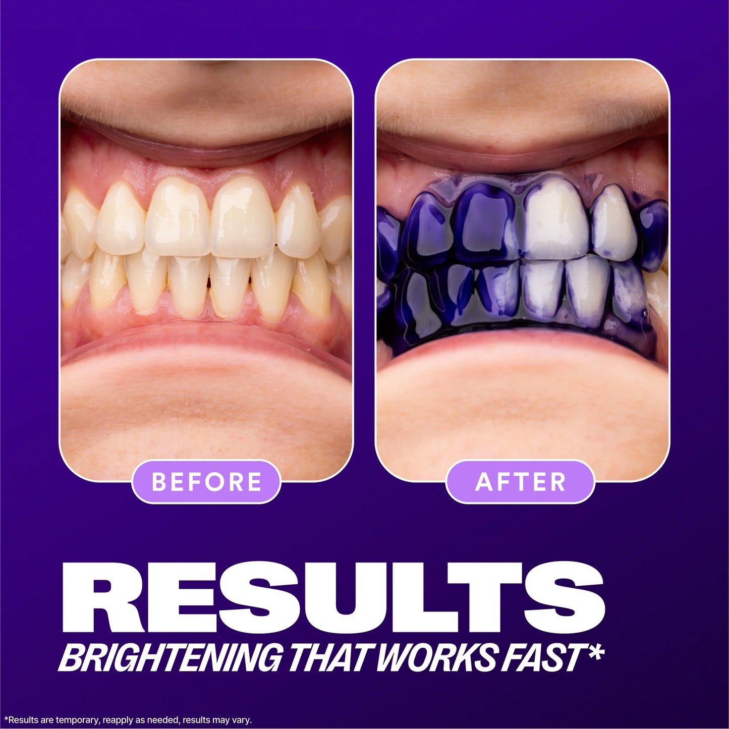 HiSmile teeth Whitening